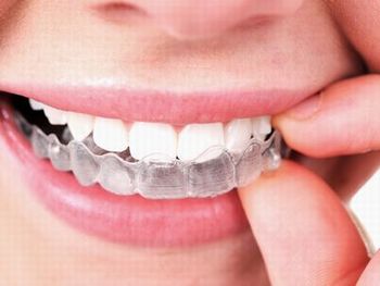 二俣川（横浜市旭区）の歯医者、ニュータウンはぐくみ歯科の矯正治療