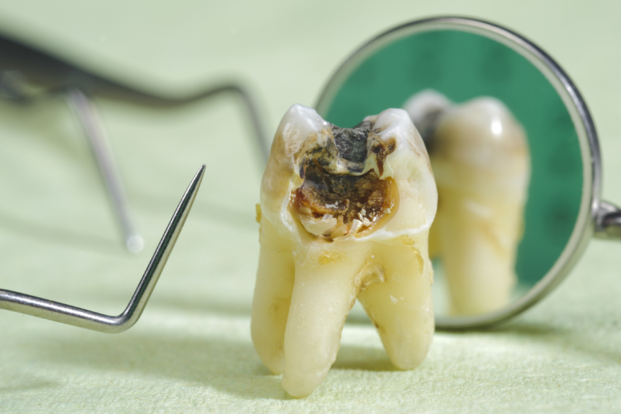 二俣川（横浜市旭区）の歯医者、ニュータウンはぐくみ歯科の虫歯治療