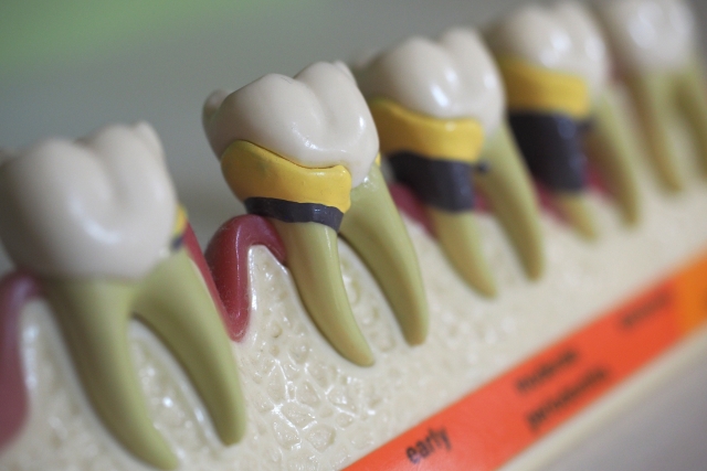 二俣川（横浜市旭区）の歯医者、ニュータウンはぐくみ歯科の歯周病治療