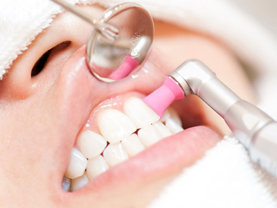 二俣川（横浜市旭区）の歯医者、ニュータウンはぐくみ歯科のクリーニング
