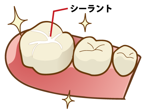 二俣川（横浜市旭区）の歯医者、ニュータウンはぐくみ歯科のシーラント