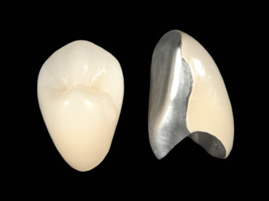 二俣川（横浜市旭区）の歯医者、ニュータウンはぐくみ歯科の保険治療でも「白い歯」に。硬質レジン前装冠